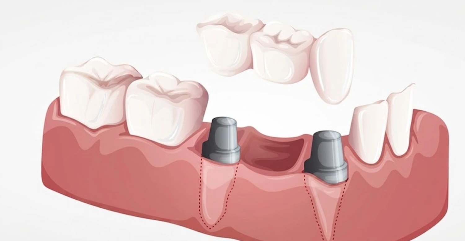 Fixed Partial Dentures
